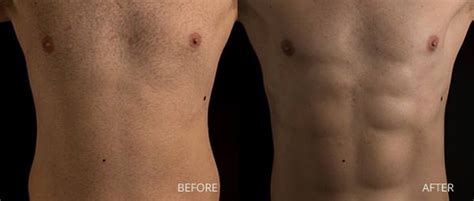 male liposuction miami|Male Liposuction in Miami, FL